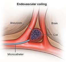 Endovascular Coiling - Health Encyclopedia - University of Rochester  Medical Center